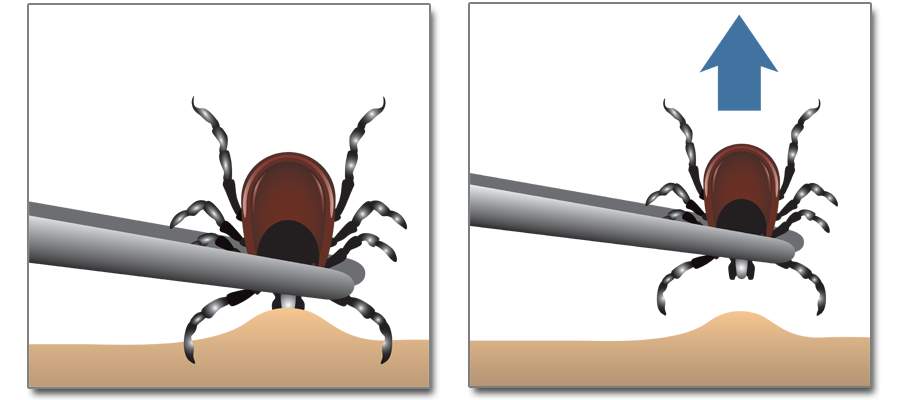 usuwanie kleszcza pęsetą